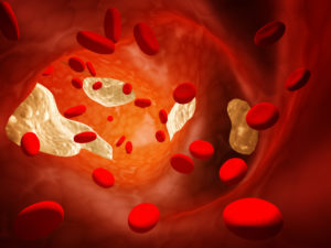 Atherosclerosis - clogged artery - High Cholesterol Oak Brook, IL