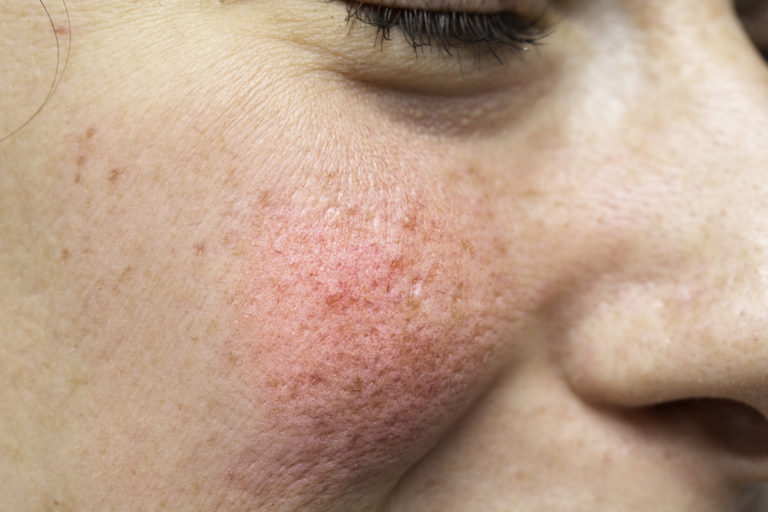 A macro view on the cheek of a young woman with severe erythema